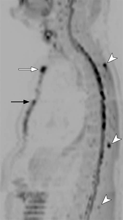 Image result for Multiple Myeloma Imaging