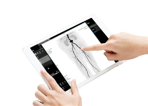 Afbeeldingsresultaten voor Angiogram Procedure