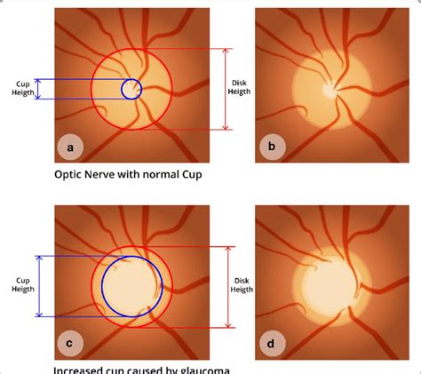 Normal Optic Nerve Optos に対する画像結果