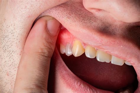 Afbeeldingsresultaten voor Bleeding around Tooth