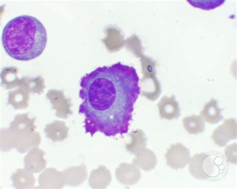 Image result for Flame Cells Multiple Myeloma