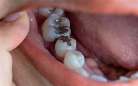 Afbeeldingsresultaten voor Side Tooth Fell Out