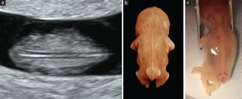 Image result for Anencephaly 8 Week Ultrasound