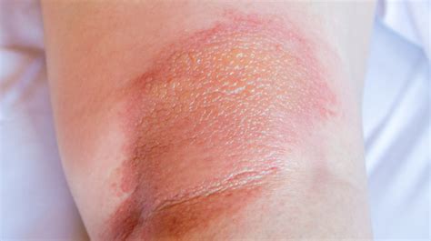 What Does Eczema Look Like に対する画像結果