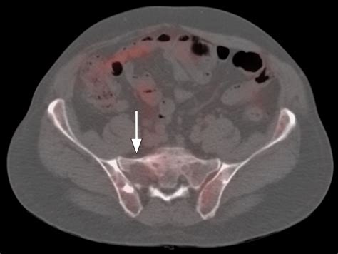 Image result for Multiple Myeloma Imaging