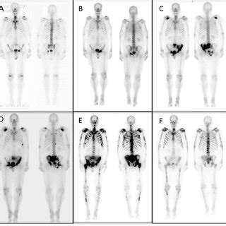 Toradh íomhá ar Radionuclide Bone Scan
