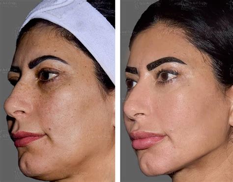 Spring Thread Lift Before and After に対する画像結果