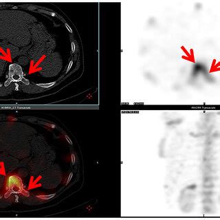 Toradh íomhá ar Radionuclide Bone Scan