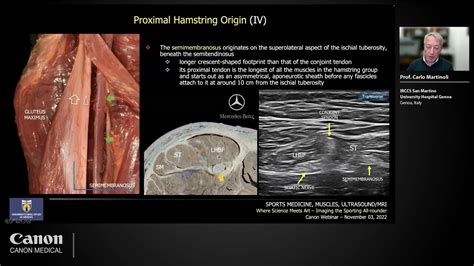 Image result for Lower Hamstring Tear Injection