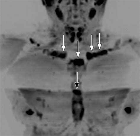 Image result for Multiple Myeloma Imaging