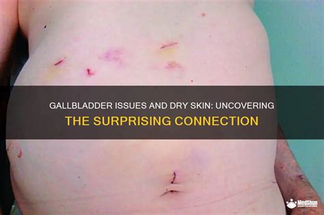 Image result for Gallbladder Skin Rash