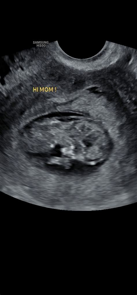 Afbeeldingsresultaten voor Ultrasound ID Code Roblox