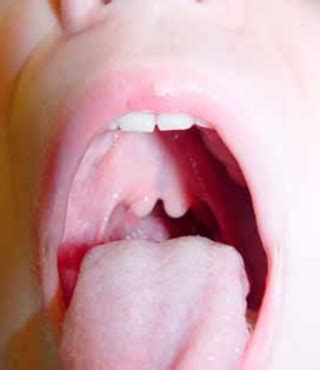 Image result for Palatoschisis Types