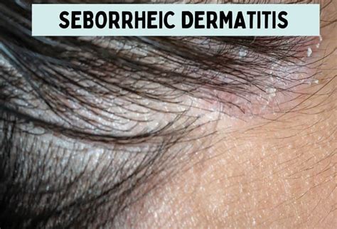 Seborrheic Dermatitis: Symptoms, Causes & Treatments