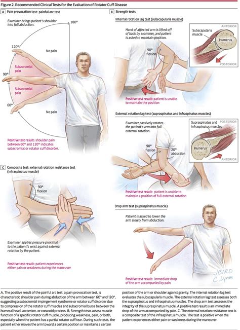 Afbeeldingsresultaten voor Lag Test Shoulder Pain