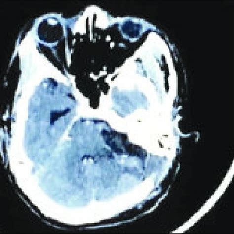 Image result for Brain Stem Compression