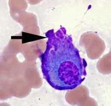 Image result for Flame Cells Multiple Myeloma