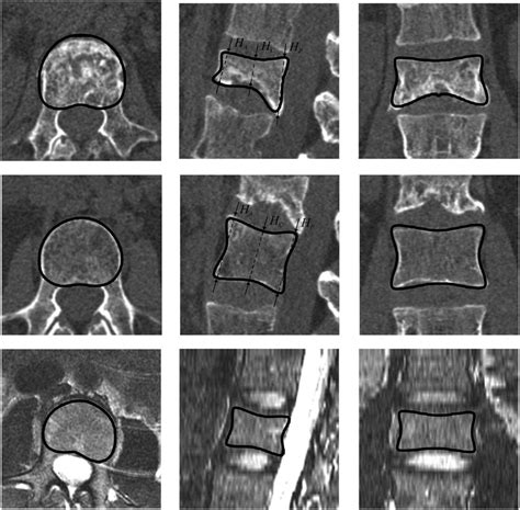 Modic III に対する画像結果