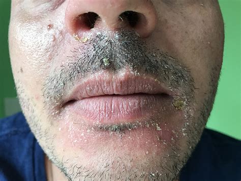 Image result for Sebaceous Dermatitis