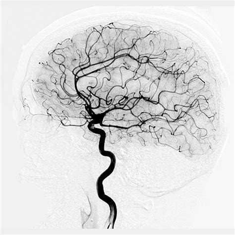 Angiography に対する画像結果