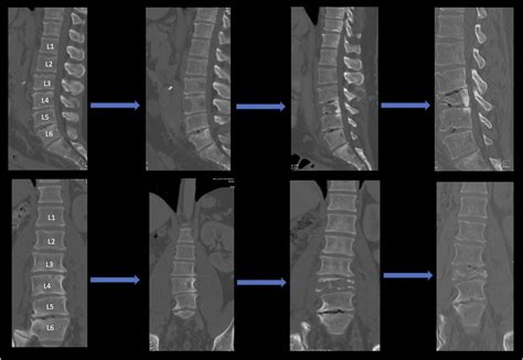 Modic III に対する画像結果