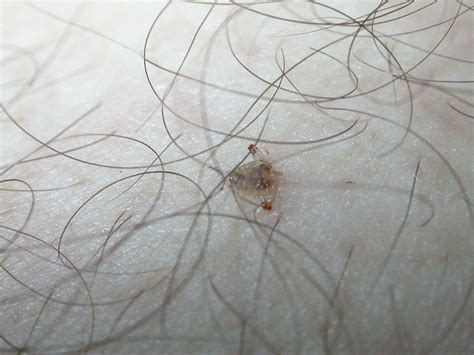 What Do Body Lice Look Like के लिए छवि परिणाम