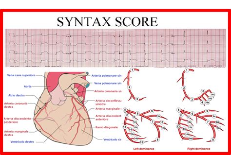 Image result for Syntax Score Chart