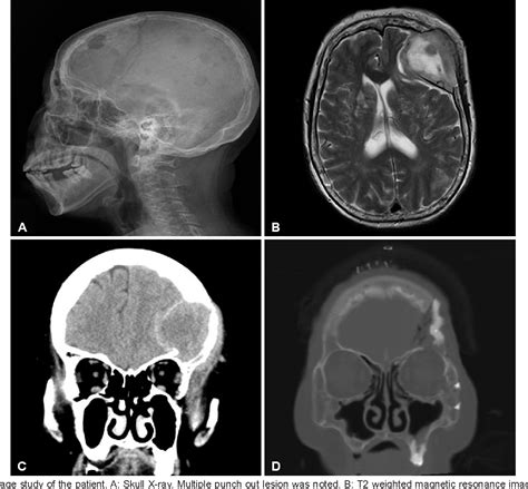Image result for Multiple Myeloma Brain