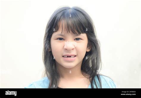 Afbeeldingsresultaten voor Side Tooth Fell Out