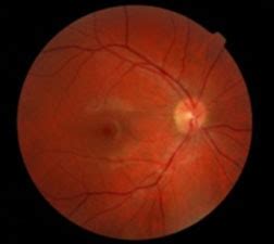 Normal Optic Nerve Optos に対する画像結果