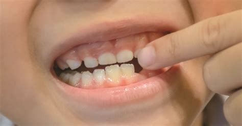 Image result for First Tooth Fall Out