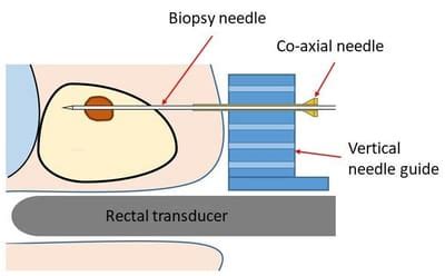 Transperineal Probe に対する画像結果