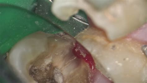 Cracked Tooth Treatment | ACT Endodontics