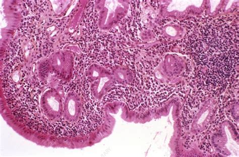 Image result for Gallbladder Skin Rash