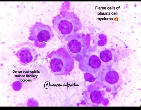 Image result for Flame Cells Multiple Myeloma