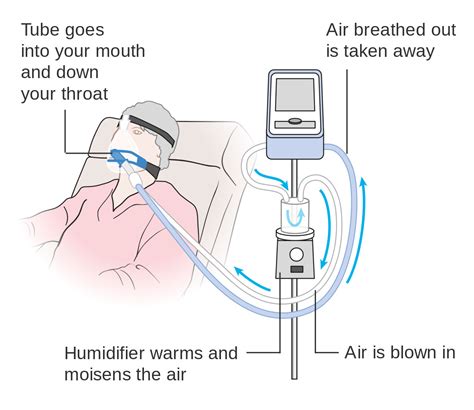 Image result for How Does Ventilator Work