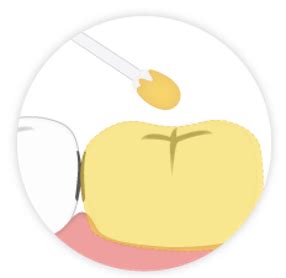 Image result for AFV Tooth Fells Out