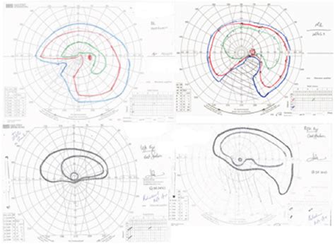 Image result for Aion Visual Field