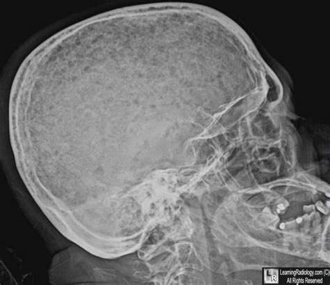 Image result for Multiple Myeloma Brain