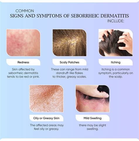 Image result for Sebaceous Dermatitis