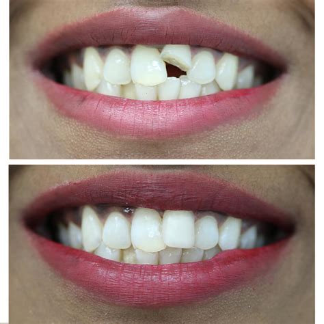 Image result for Tooth Breaking