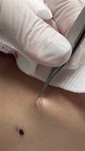 The Squeeze Is Only Half The Job | Dr. Pimple Popper vs. Steatocystomas