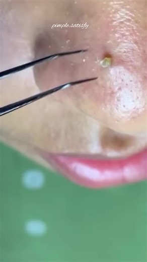 Satisfying Blackhead and Pimple Removal Compilation