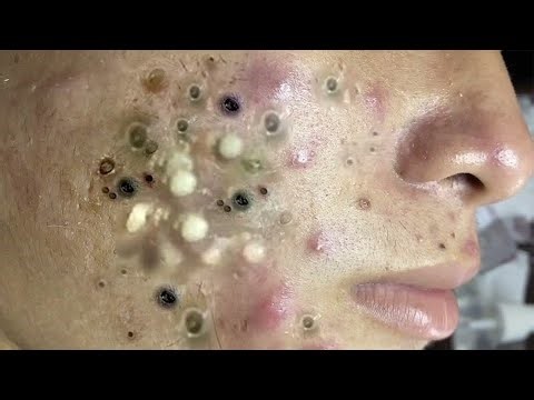 Satisfying Blackhead Removal – Deep Acne Cleaning for Ultimate Relaxation - 293403