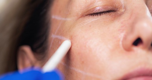 What is a thread lift? Experts discuss the pros and cons of facial threading