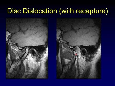 Temporomandibular Joint 1