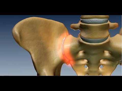 Where is the Sacroiliac Joint? Anatomy of the Sacroiliac Joint