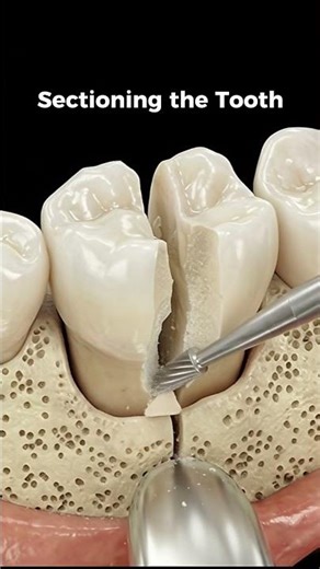 How to Extract a Stuck Molar: Converting to Single Roots 🦷