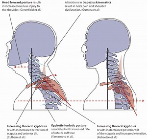 Correcting Forward Head Posture - Causes & Ways To Help