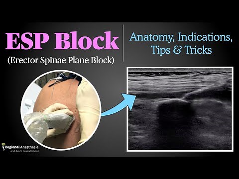 Erector Spinae Plane (ESP) Block